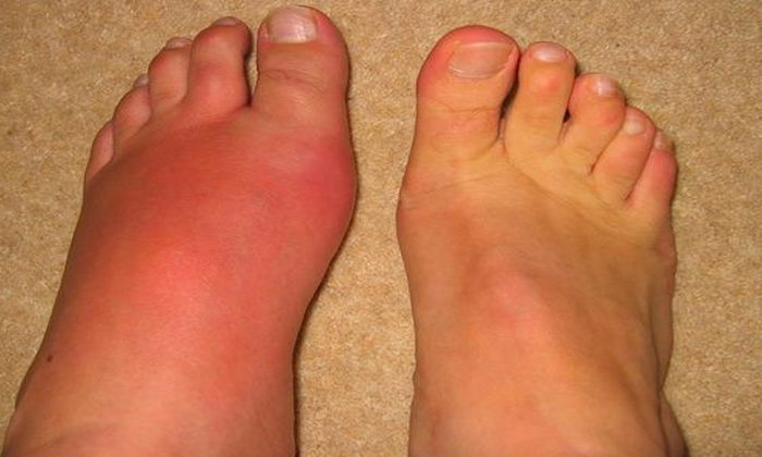 Māori and Pacific peoples more likely to suffer from gout, less likely to be treated