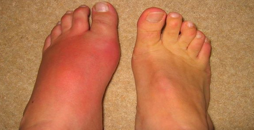 Māori and Pacific peoples more likely to suffer from gout