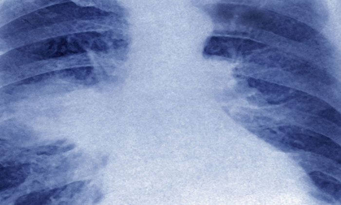 Cultural intervention can cut lung cancer death rate