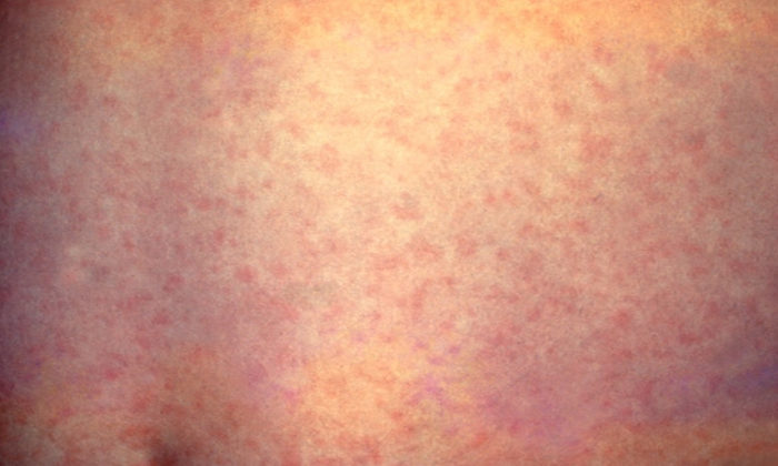 Vaccination rethink needed in wake of measles outbreak
