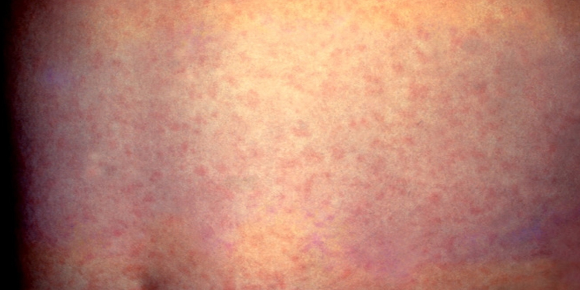 Measles outbreak highlights health sector flaws