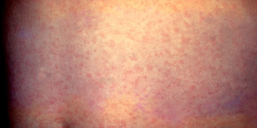 Dark days for Samoa as measles outbreak rages