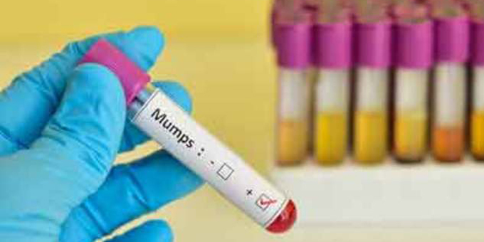 Quarantine mandate for mumps
