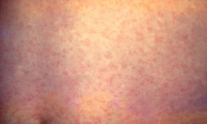 Vaccine catch up as measles lurks